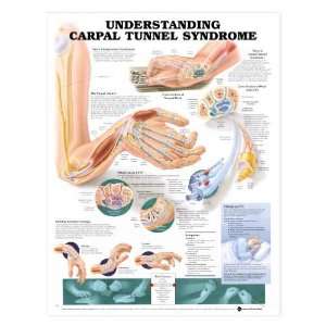 Carpal Tunnel Syndrome Chart  Industrial & Scientific