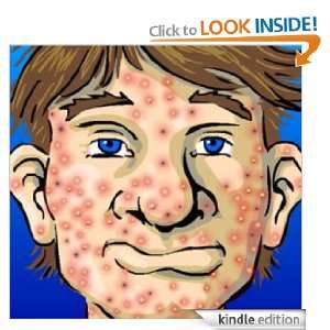How to Handle Acne For Good Bob Chandler  Kindle Store